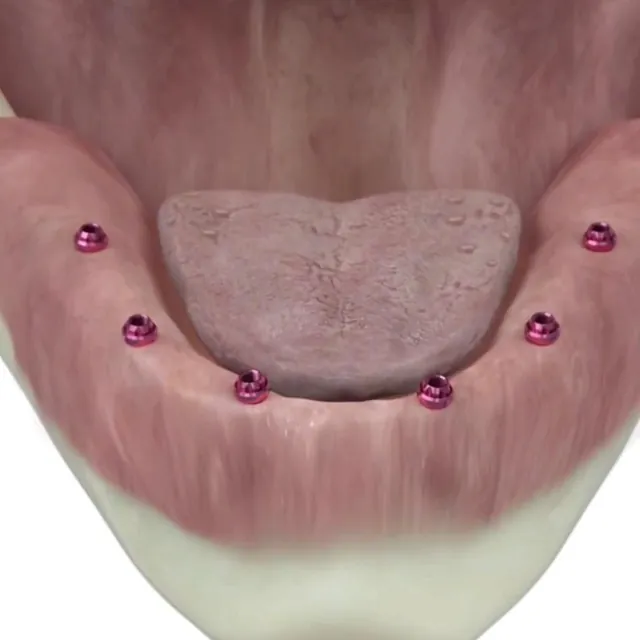 Centro Dental Correa implantologia