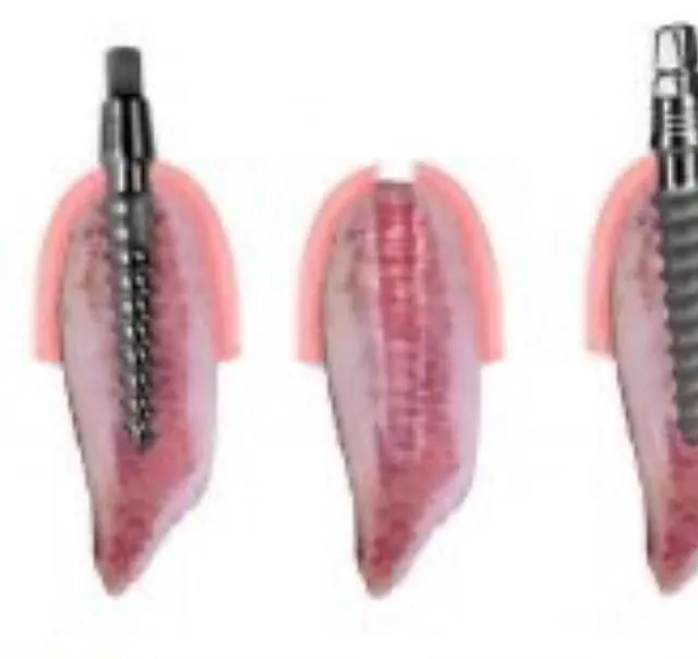 Centro Dental Correa implantologia
