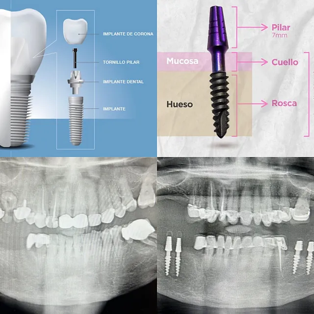 Centro Dental Correa implantologia